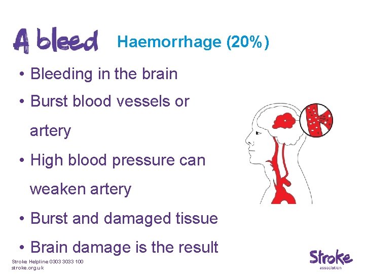 Haemorrhage (20%) • Bleeding in the brain • Burst blood vessels or artery •