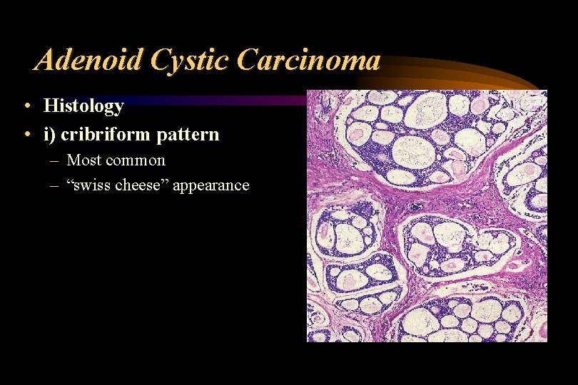 Adenoid Cystic Carcinoma • Histology • i) cribriform pattern – Most common – “swiss