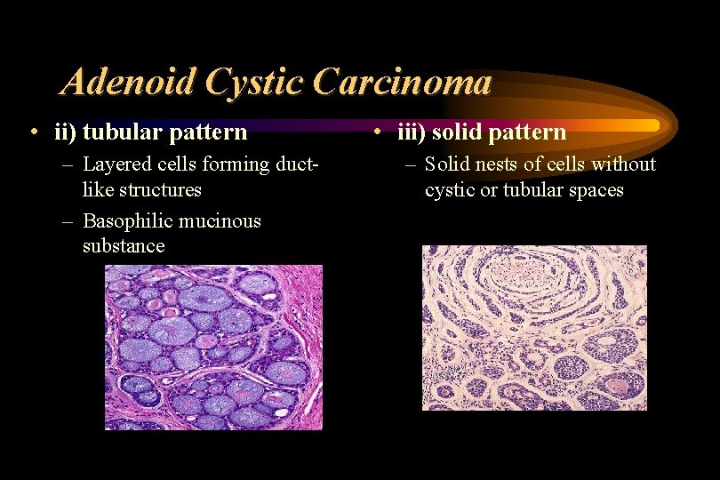 Adenoid Cystic Carcinoma • ii) tubular pattern – Layered cells forming ductlike structures –