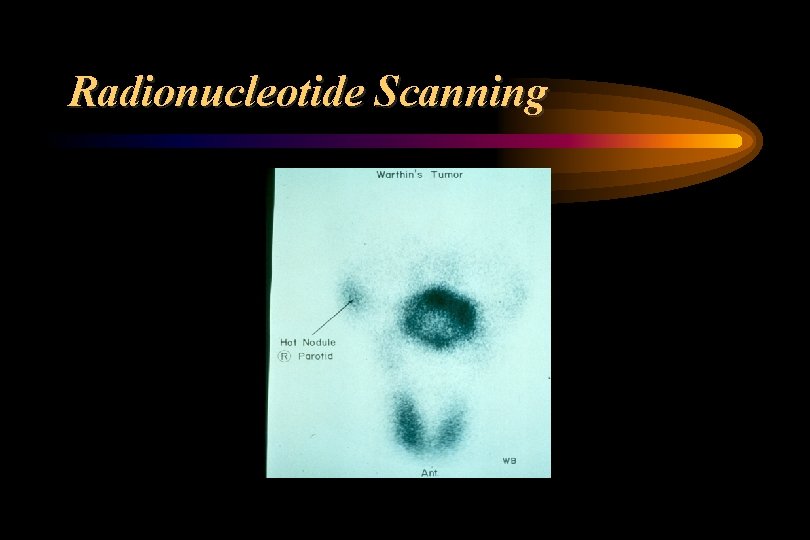 Radionucleotide Scanning 