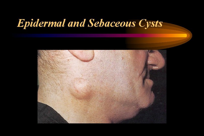 Epidermal and Sebaceous Cysts 