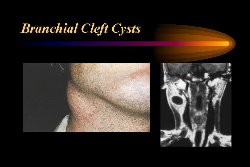 Branchial Cleft Cysts 