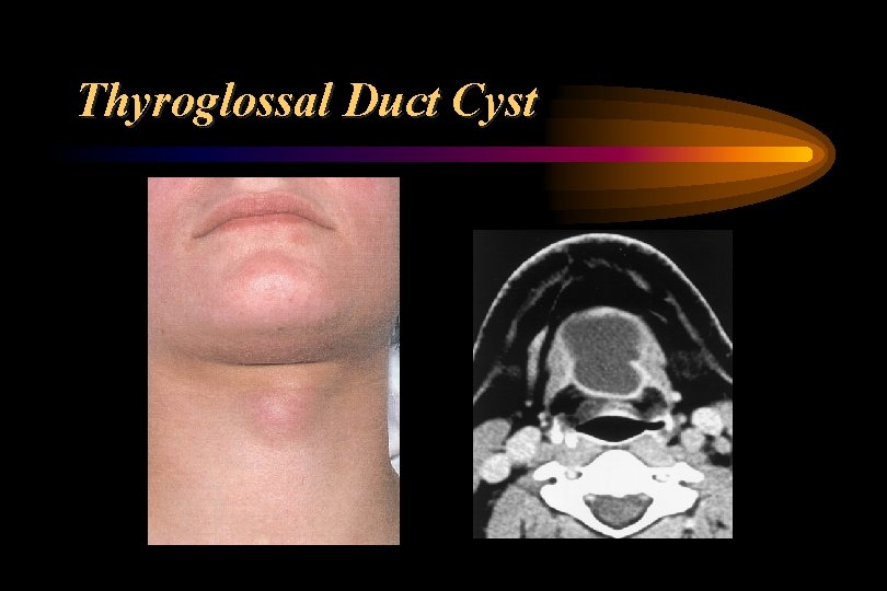 Thyroglossal Duct Cyst 