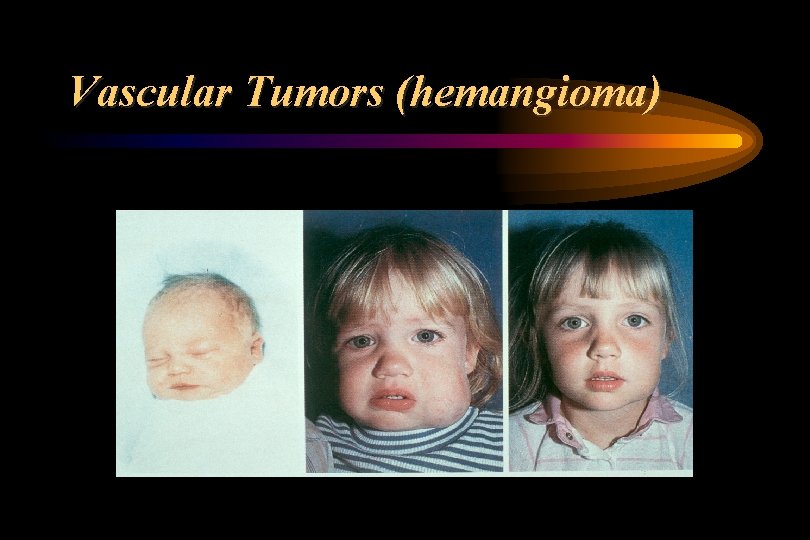 Vascular Tumors (hemangioma) 