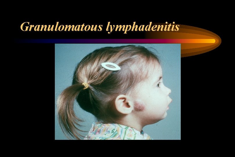 Granulomatous lymphadenitis 