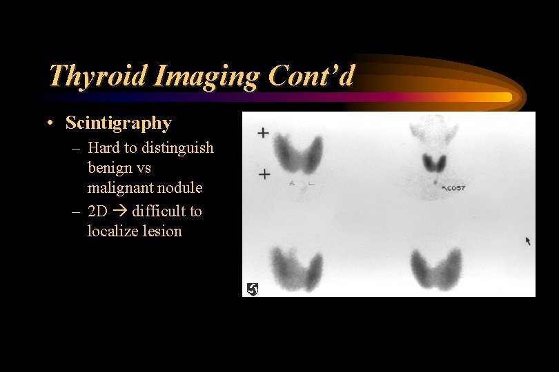 Thyroid Imaging Cont’d • Scintigraphy – Hard to distinguish benign vs malignant nodule –