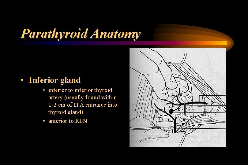 Parathyroid Anatomy • Inferior gland • inferior to inferior thyroid artery (usually found within