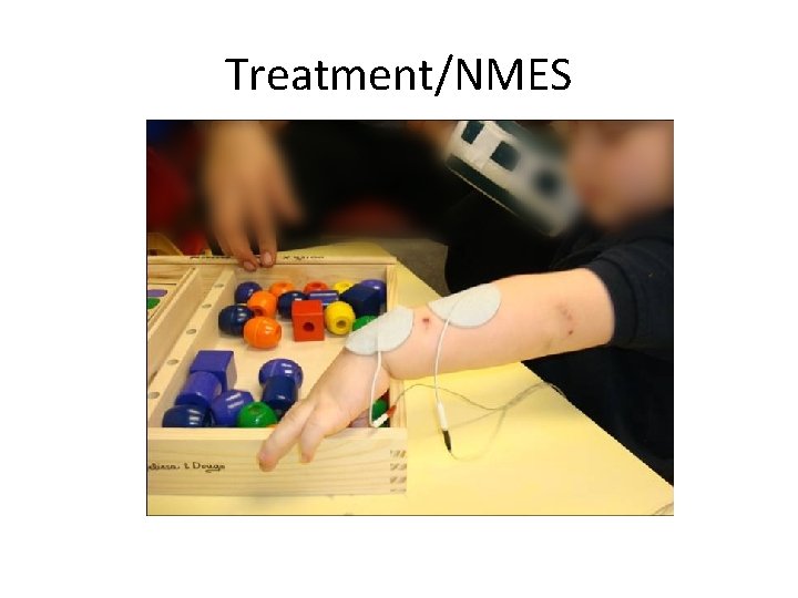 Treatment/NMES 