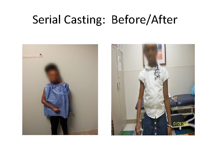 Serial Casting: Before/After 