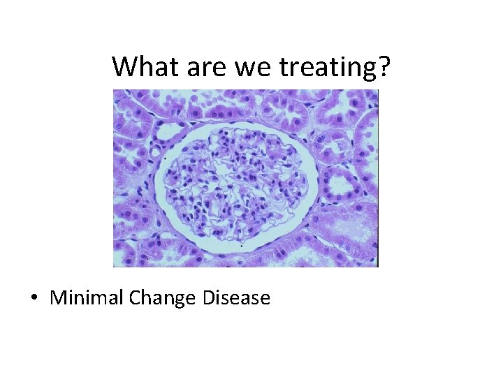 What are we treating? • Minimal Change Disease 