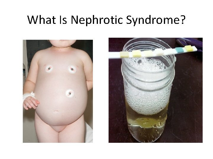 What Is Nephrotic Syndrome? 