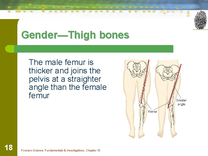 Gender—Thigh bones The male femur is thicker and joins the pelvis at a straighter