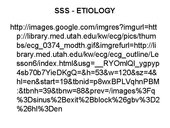SSS - ETIOLOGY http: //images. google. com/imgres? imgurl=htt p: //library. med. utah. edu/kw/ecg/pics/thum bs/ecg_0374_modth.