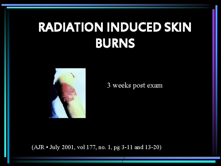 RADIATION INDUCED SKIN BURNS 3 weeks post exam (AJR • July 2001, vol 177,