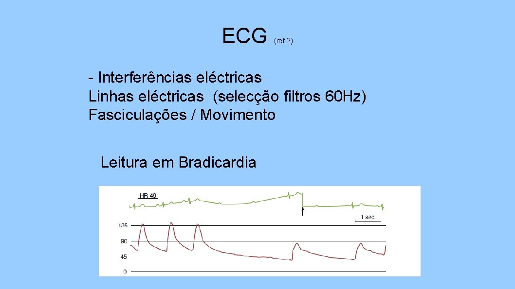 ECG (ref. 2) - Interferências eléctricas Linhas eléctricas (selecção filtros 60 Hz) Fasciculações /