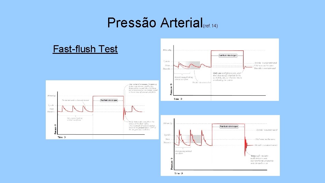 Pressão Arterial Fast-flush Test (ref. 14) 