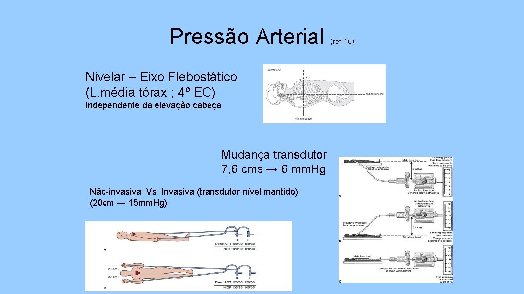 Pressão Arterial Nivelar – Eixo Flebostático (L. média tórax ; 4º EC) Independente da