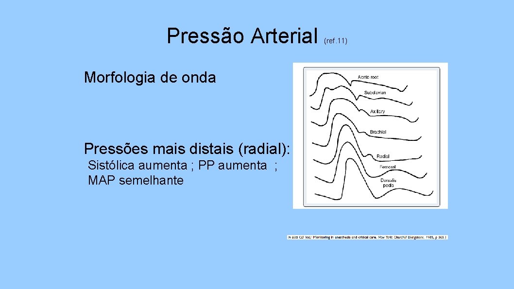 Pressão Arterial Morfologia de onda Pressões mais distais (radial): Sistólica aumenta ; PP aumenta