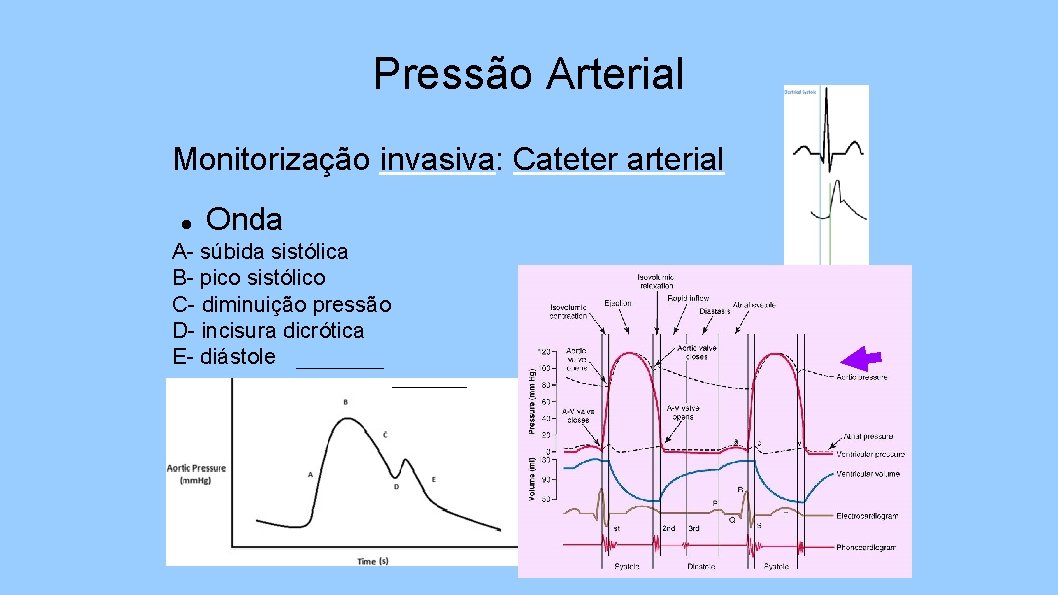 Pressão Arterial Monitorização invasiva: Cateter arterial Onda A- súbida sistólica B- pico sistólico C-