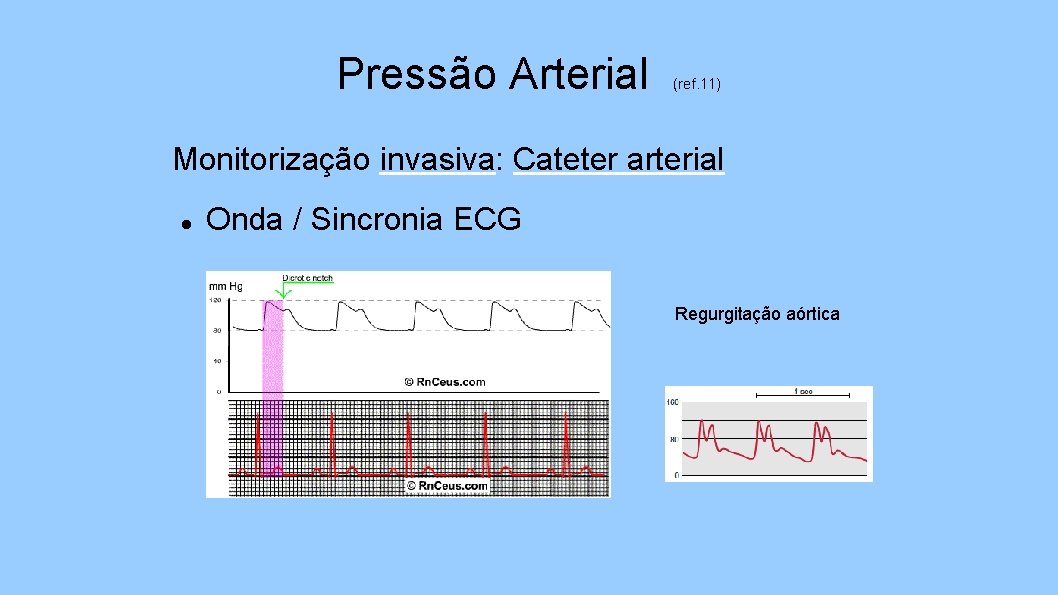 Pressão Arterial (ref. 11) Monitorização invasiva: Cateter arterial Onda / Sincronia ECG Regurgitação aórtica