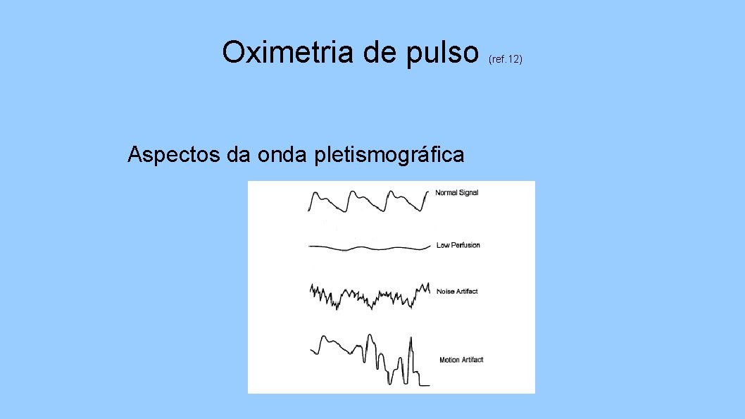 Oximetria de pulso Aspectos da onda pletismográfica (ref. 12) 