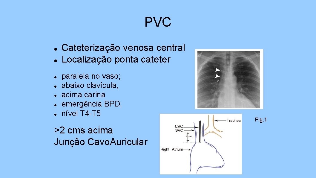 PVC Cateterização venosa central Localização ponta cateter paralela no vaso; abaixo clavícula, acima carina