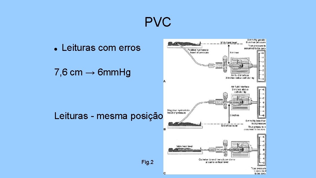 PVC Leituras com erros 7, 6 cm → 6 mm. Hg Leituras - mesma