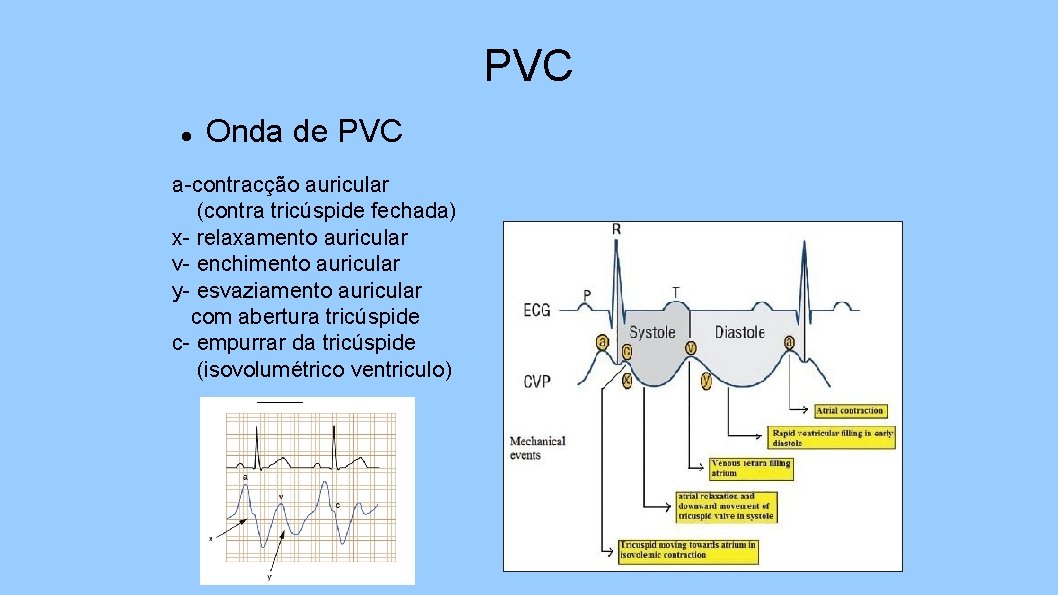 PVC Onda de PVC a-contracção auricular (contra tricúspide fechada) x- relaxamento auricular v- enchimento