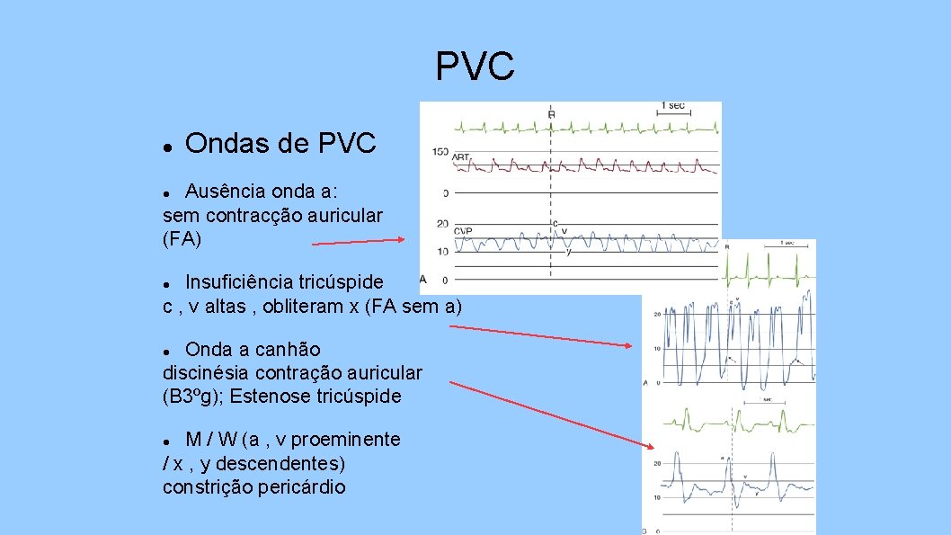 PVC Ondas de PVC Ausência onda a: sem contracção auricular (FA) Insuficiência tricúspide c