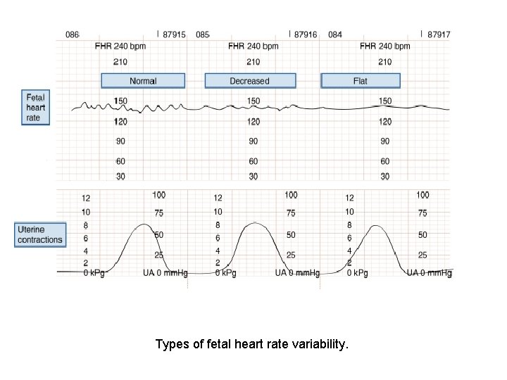 Types of fetal heart rate variability. 