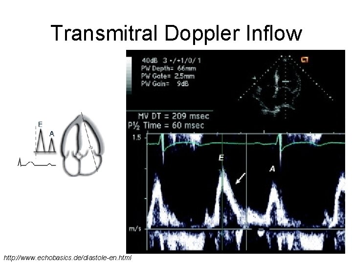 Transmitral Doppler Inflow http: //www. echobasics. de/diastole-en. html 