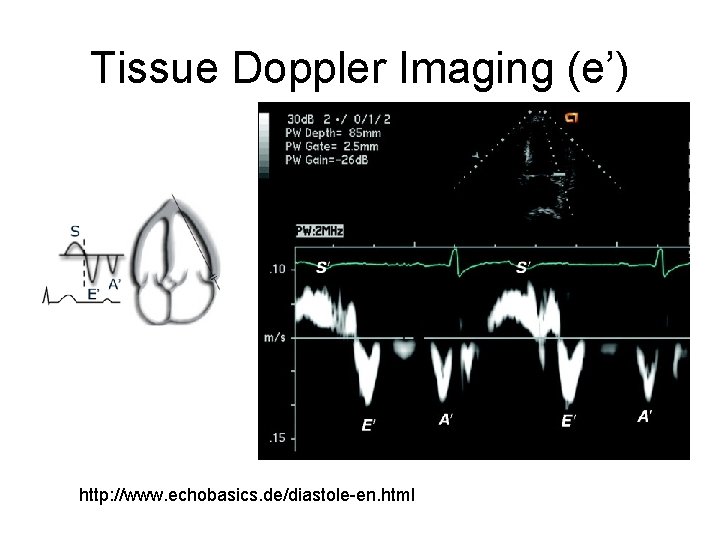 Tissue Doppler Imaging (e’) http: //www. echobasics. de/diastole-en. html 