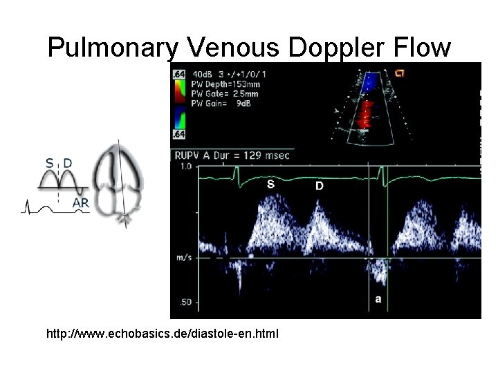 Pulmonary Venous Doppler Flow http: //www. echobasics. de/diastole-en. html 