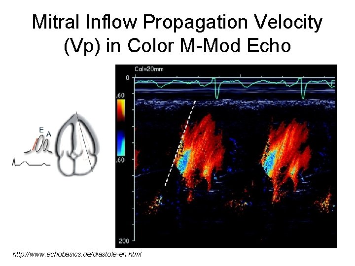 Mitral Inflow Propagation Velocity (Vp) in Color M-Mod Echo http: //www. echobasics. de/diastole-en. html