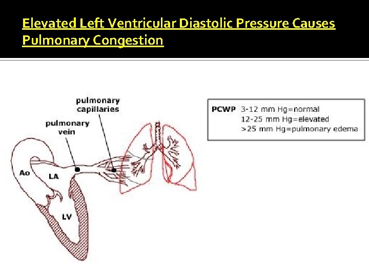 Elevated Left Ventricular Diastolic Pressure Causes Pulmonary Congestion 