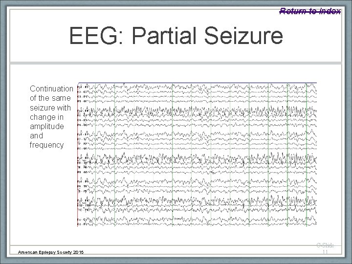 Return to index EEG: Partial Seizure Continuation of the same seizure with change in