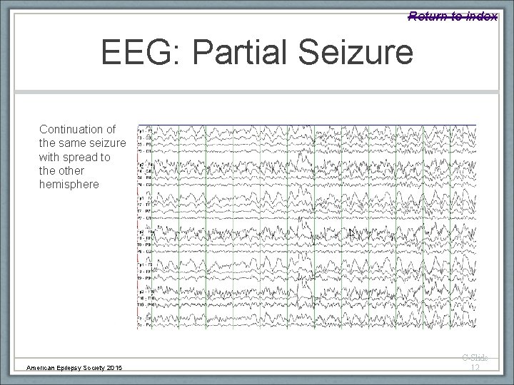 Return to index EEG: Partial Seizure Continuation of the same seizure with spread to