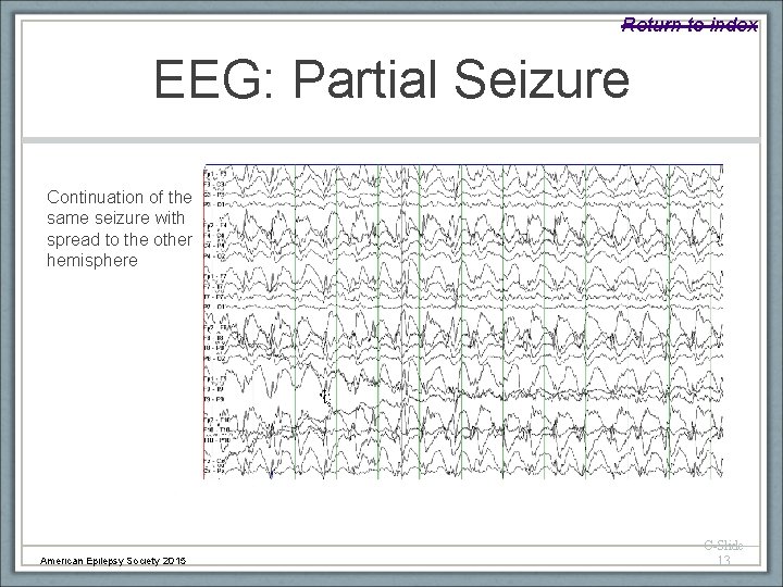 Return to index EEG: Partial Seizure Continuation of the same seizure with spread to