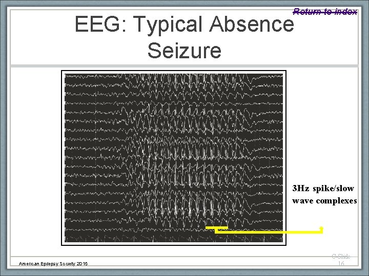 Return to index EEG: Typical Absence Seizure 3 Hz spike/slow wave complexes American Epilepsy