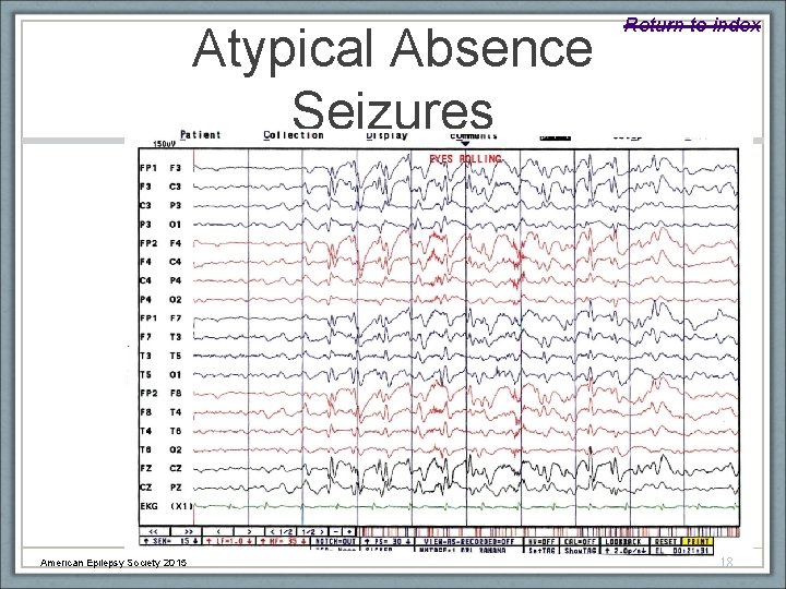 Atypical Absence Seizures American Epilepsy Society 2015 Return to index C-Slide 18 