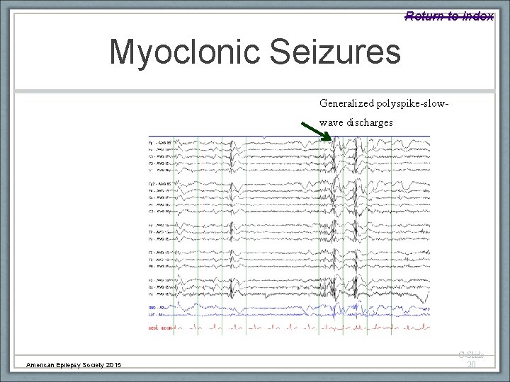 Return to index Myoclonic Seizures Generalized polyspike-slowwave discharges American Epilepsy Society 2015 C-Slide 20