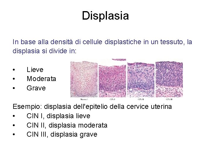 Displasia In base alla densità di cellule displastiche in un tessuto, la displasia si