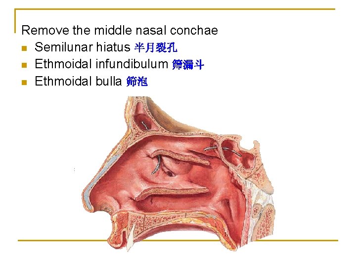 Remove the middle nasal conchae n Semilunar hiatus 半月裂孔 n Ethmoidal infundibulum 筛漏斗 n