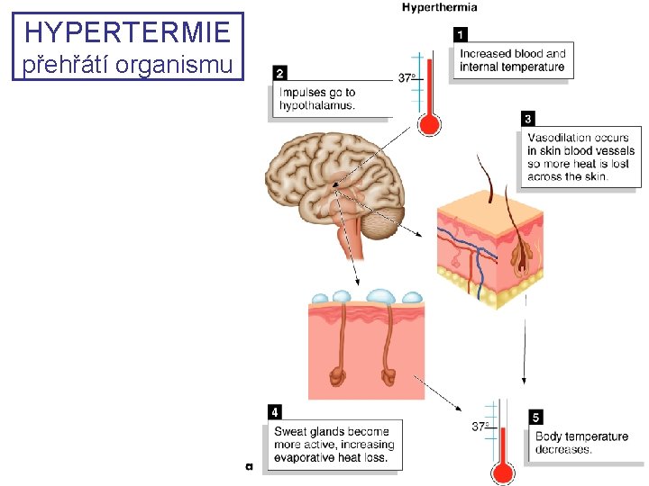 HYPERTERMIE přehřátí organismu HYPERTERMIE přehřátí organismu