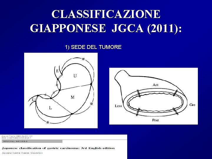 CLASSIFICAZIONE GIAPPONESE JGCA (2011): 1) SEDE DEL TUMORE 