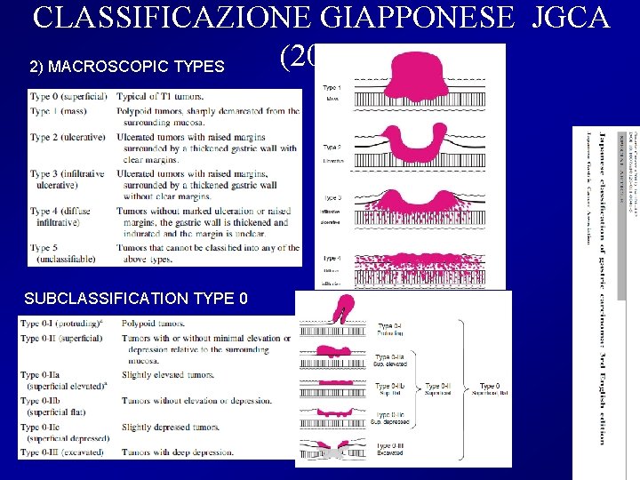 CLASSIFICAZIONE GIAPPONESE JGCA (2011) 2) MACROSCOPIC TYPES SUBCLASSIFICATION TYPE 0 