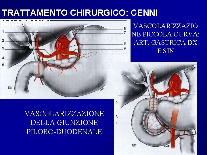 TRATTAMENTO CHIRURGICO: CENNI ANATOMICI VASCOLARIZZAZIO NE PICCOLA CURVA: ART. GASTRICA DX E SIN VASCOLARIZZAZIONE