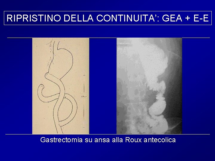 RIPRISTINO DELLA CONTINUITA’: GEA + E-E Gastrectomia su ansa alla Roux antecolica 