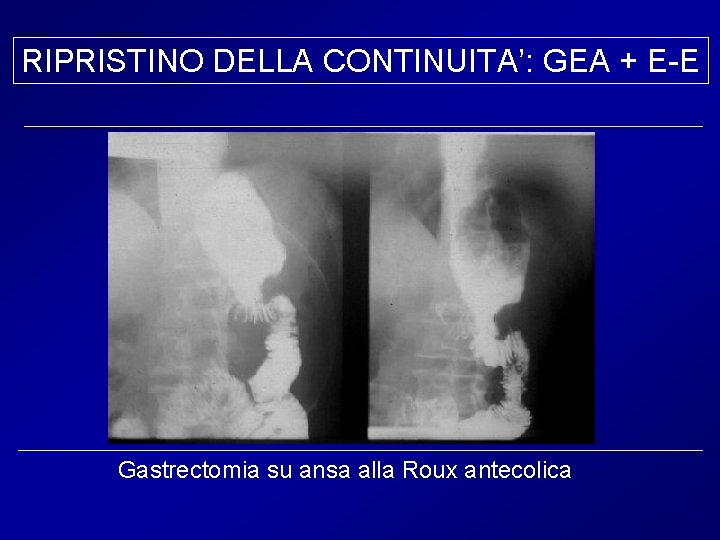 RIPRISTINO DELLA CONTINUITA’: GEA + E-E Gastrectomia su ansa alla Roux antecolica 