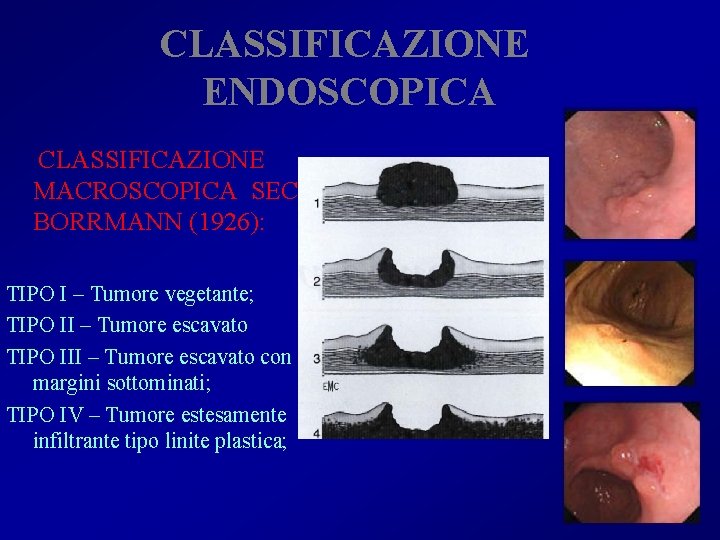 CLASSIFICAZIONE ENDOSCOPICA CLASSIFICAZIONE MACROSCOPICA SEC. BORRMANN (1926): TIPO I – Tumore vegetante; TIPO II